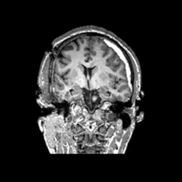 clinical-trial-could-move-the-needle-in-traumatic-brain-injury